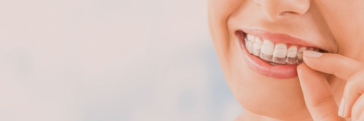 What is Invisalign?