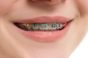 Bonaventure Dental Care The Costs of Not Wearing Your Retainer